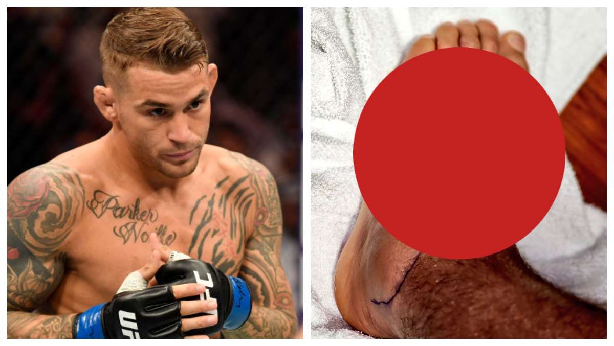 PHOTO: Dustin Poirier Shares Graphic Look At Staph Infection - ou