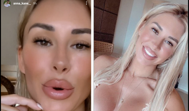 Anna Kane Uses Ex-Husband Evander Kane's Injury To Promote Her OnlyFans, Later Tries To Walk It