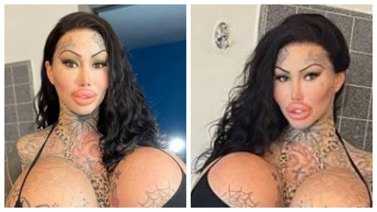 Model left with 'uniboob' after 38J implant exploded flaunts new