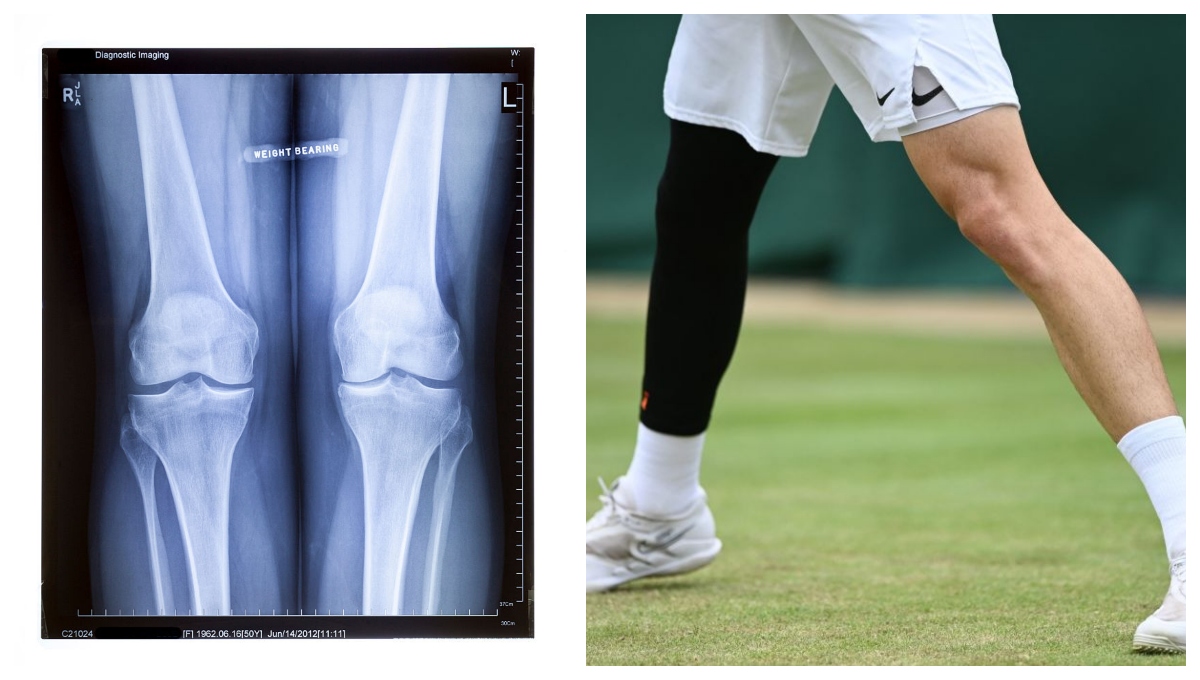 Influencer Yeferson Cossio Regrets Limb-Stretching Surgery That Added