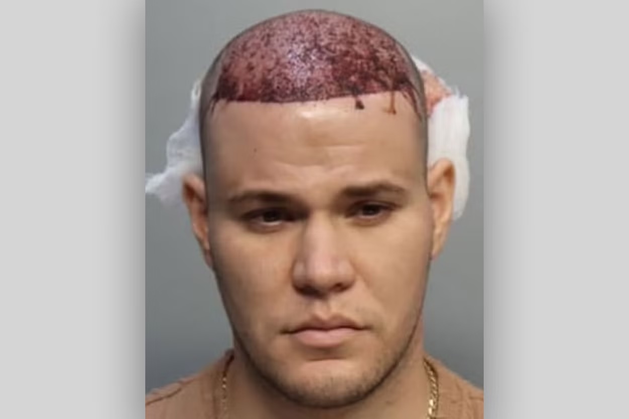 Bloody hair transplant causes chaos on Miami flight